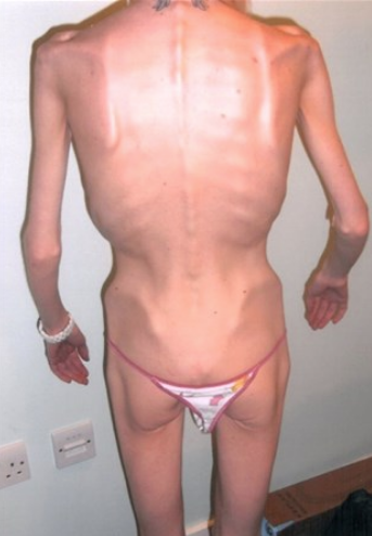 Anoreksiya'dan ölmek üzereydi! Mucizevi değişim herkesi şaşırttı - Resim: 2