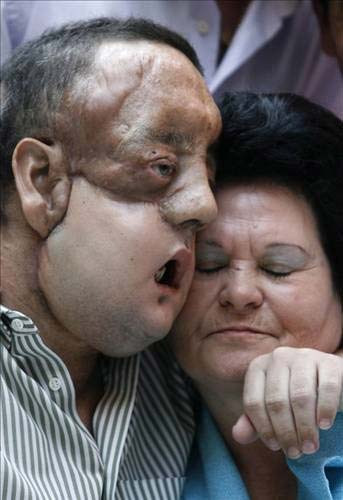 İlk tam yüz nakli - Resim: 4