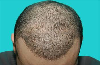 Aslında bu ünlülerin hepsi kel - Resim: 4