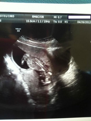 Ultrasonda gördü anne bir anda ne yapacağını şaşırdı - Resim: 4