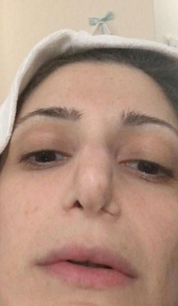 Burun estetiği yaptırdı şimdi nefes alamıyor - Resim: 2