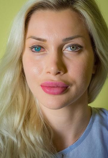 Belini inceltmişti şimdi de operasyonla göz rengini değiştirdi!  - Resim: 3