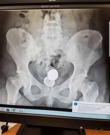 Cinsel İlişki oyuncağı bağırsaklarına kaçtı çıkarmayı denedi ama... - Resim: 4