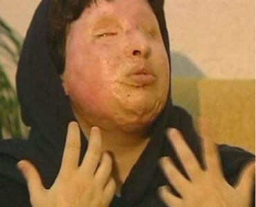 Yüzüne kezzap atıldı - Resim: 1