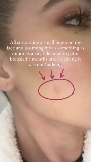 Ekran yıldızının kanser kabusu 'Yüzümden tümör aldırdım' dedi hastalığa dikkat çekti! - Resim: 0