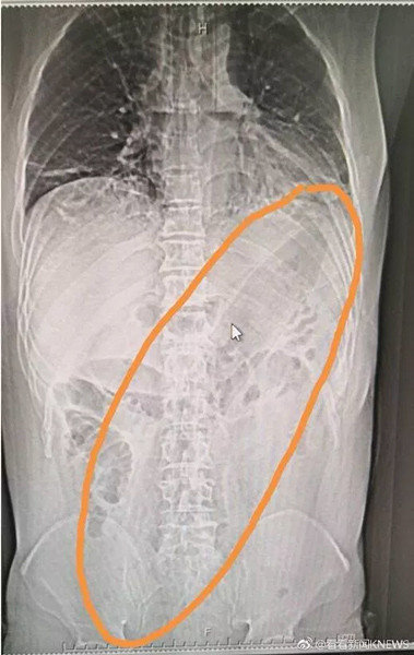 Karın ağrısıyla hastaneye koştu içinden devasa bir patlıcan çıktı - Resim: 1