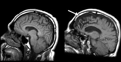 Bunamaya (demans) karşı tüketilmesi gereken 7 önemli besin - Resim: 3