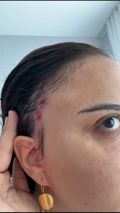 'Badem Göz' olmak için estetik masasına yattı sona faciayla bitti! Eski halinden eser yok şimdi - Resim: 4