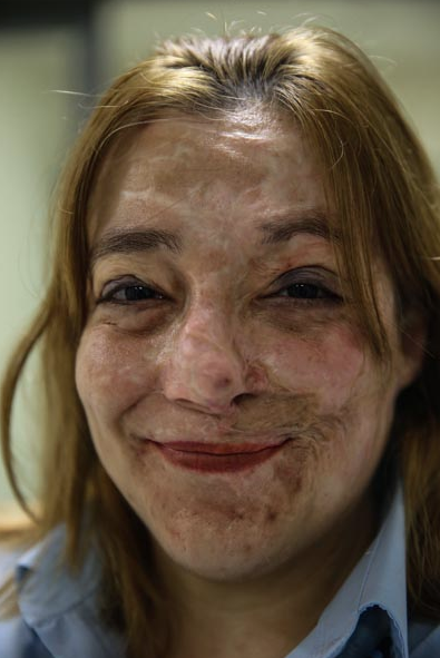 Hayatı kabusa dönmüştü! Şimdi moral kaynağı oldu - Resim: 1