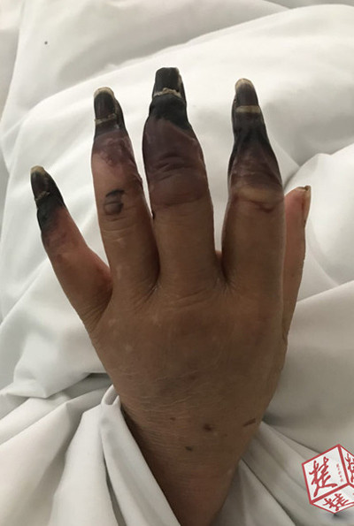 Küçük yara deyip önemsemedi parmaklarının kesilmesi ile karşı karşıya kaldı - Resim: 4