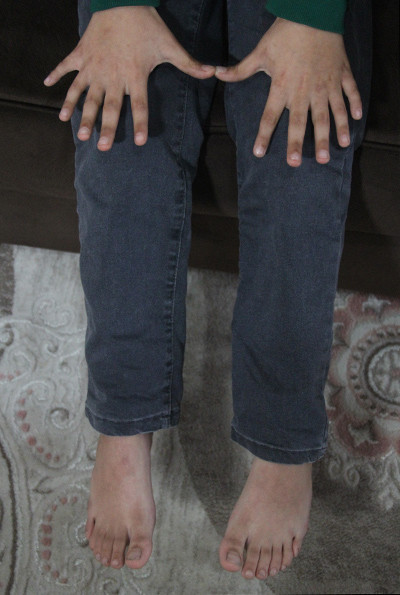 Adana'da yaşıyor 9 yaşındaki Demirhan'ın tam 24 parmağı bulunuyor - Resim: 1