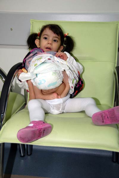 İkizini karnında taşıyor - Resim: 2