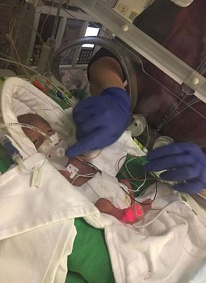 Mucize bebek 1 kilo bile doğmadı ama... - Resim: 2