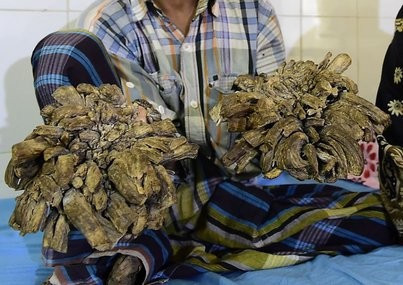 Ağaç Adam dünyanın dilinde! 10 yaşından beri böyle - Resim: 2