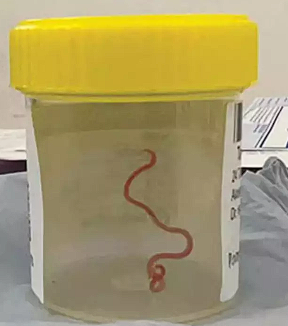 Unutkanlık ve depresyon şikayetiyle hastaneye giden kadının beyninden solucan çıktı - Resim: 0