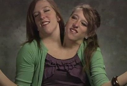 Tek vücutta iki kişi yaşıyorlar! Son halleri... - Resim: 2