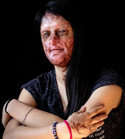 Asitle yüzü yakılan Berfin Özek'ten karar sonrası zor soru - Resim: 1