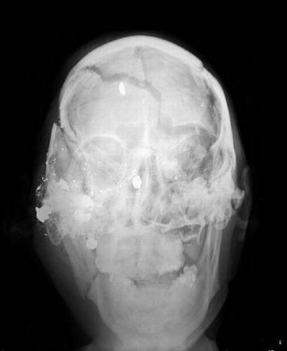 Hayrete düşüren röntgen filmleri  - Resim: 3