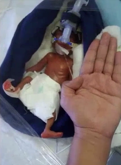 400 gram doğdu ayağındaki o detay her şeyi değiştirdi - Resim: 3