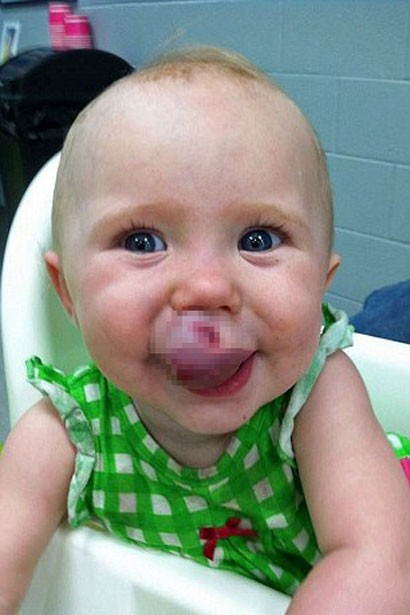 Küçük kızın dudağı morardı kanser çıktı... - Resim: 3