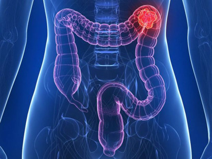 Kolon kanserinin en önemli belirtisi! Eğer yumurta akı gibi bir salgı varsa... - Resim: 0