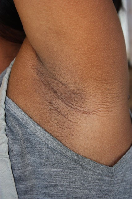 Koltuk altı kararmasından selülite kadar kesin çözüm! - Resim: 2