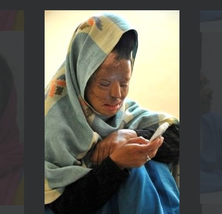 Asit saldırısına uğradı hayatı mahvoldu! - Resim: 3