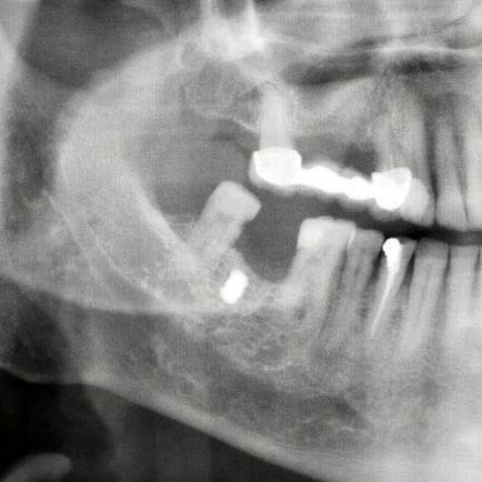 Erzincan'da dişçiye gitti 15 yıl sonra haberdar oldu kurşun büyüklüğündeydi - Resim: 0