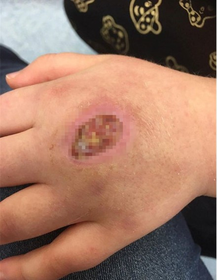 Örümcek ısırığı deyip geçmeyin bu hale getirdi - Resim: 2