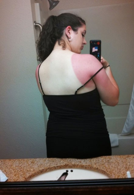 Güneşin acımadığı tatilcilere bakın neler oldu - Resim: 3