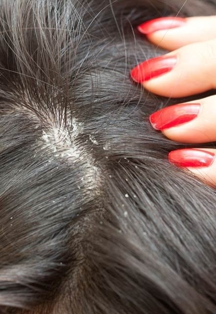 Saçlarını aspirinle yıkayıp bekletti sonuç sizi şoke edecek  - Resim: 4