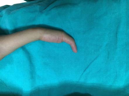 İki elinde sadece bir parmak vardı mucize ameliyat - Resim: 4