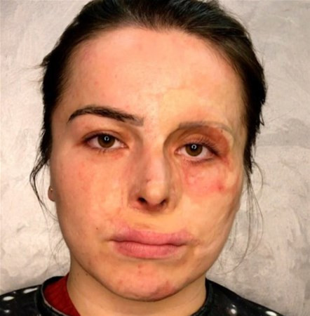 Yüzü yanınca bu hale geldi bakın sonra neler oldu  - Resim: 1