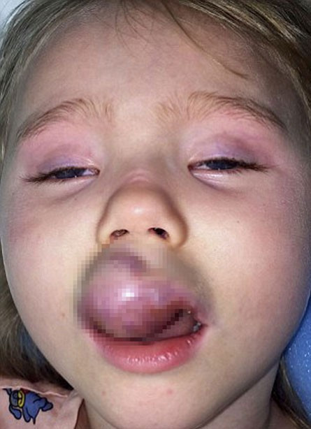Küçük kızın dudağı morardı kanser çıktı... - Resim: 1