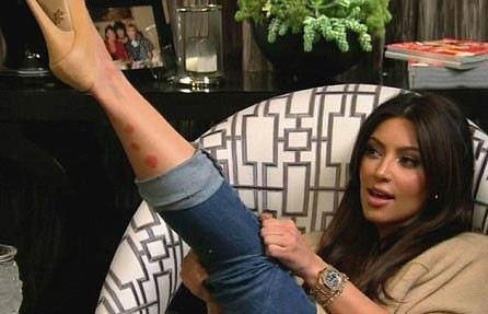 Kardashian'ın hastalığı yüzüne sıçradı ! - Resim: 1