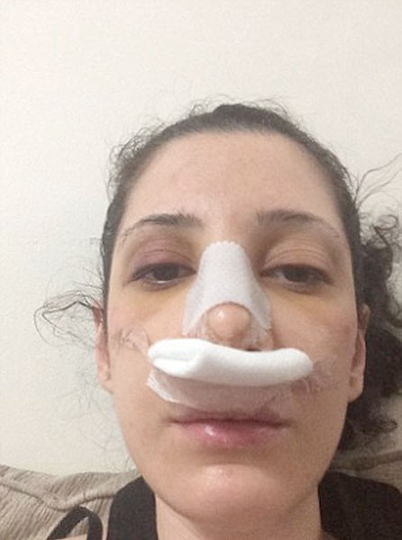 Burun estetiği yaptırdı şimdi nefes alamıyor - Resim: 3