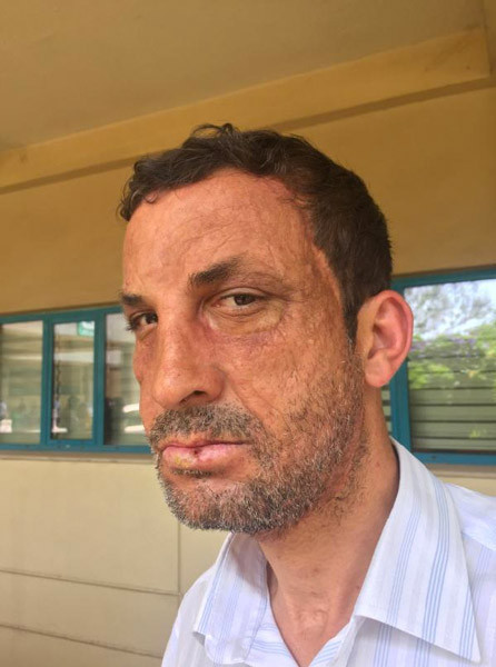 Türkiye'nin ilk yüz nakliydi! Uğur Acar'ın son hali görenleri şaşkına çevirdi - Resim: 2