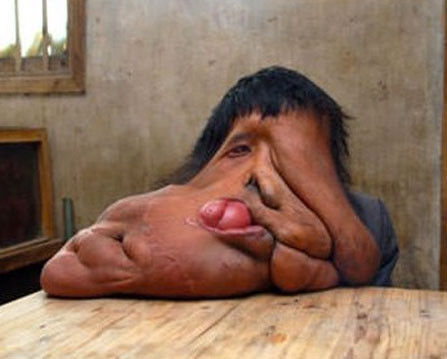 Dünyanın en tuhaf hastalıkları - Resim: 2