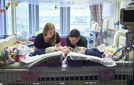 Yapışık ikizlerin ameliyatla ayrıldı  - Resim: 3