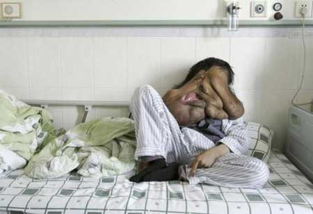 Yüzünde 23 KİLO UR var! - Resim: 2