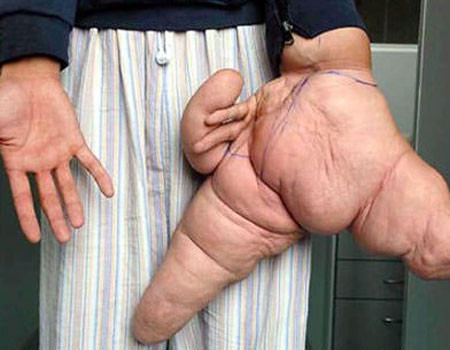 Dünyanın en tuhaf hastalıkları - Resim: 4