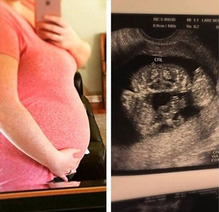 Yapışık ikizlerin ameliyatla ayrıldı  - Resim: 4