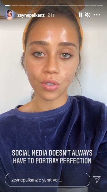 Hamdi Alkan'ın kızı Zeynep Alkan yüzündeki sivilceleri paylaşarak isyan etti! - Resim: 3