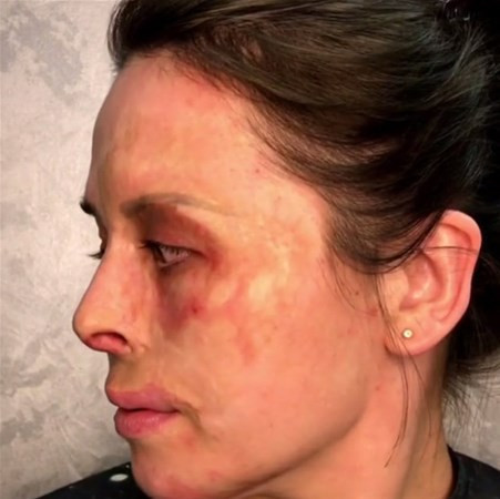 Yüzü yanınca bu hale geldi bakın sonra neler oldu  - Resim: 3