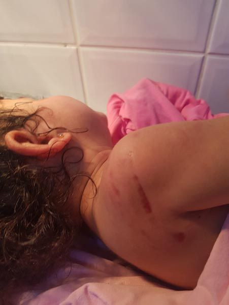 Rottweiler'ın saldırdığı minik Almila ölümden döndü - Resim: 2