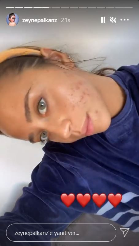 Hamdi Alkan'ın kızı Zeynep Alkan yüzündeki sivilceleri paylaşarak isyan etti! - Resim: 4