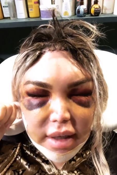 'Ken Bebek' Rodrigo Alves estetik sonrası halini takipçileriyle paylaştı! - Resim: 3