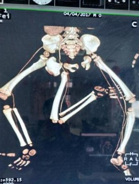 Dünyayı ayağa kaldırdı üç bacaklı çocuk kıyamet alameti gibi - Resim: 4