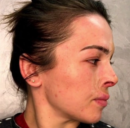 Yüzü yanınca bu hale geldi bakın sonra neler oldu  - Resim: 2