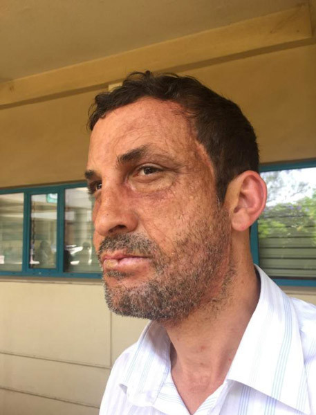 Türkiye'nin ilk yüz nakliydi! Uğur Acar'ın son hali görenleri şaşkına çevirdi - Resim: 3